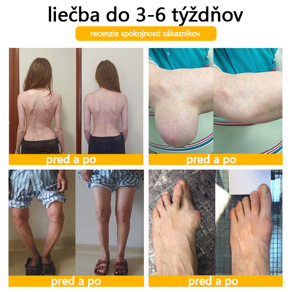 🦴ADNOON® Krém na hojenie kostí s botulotoxínom a včelím jedom ⭐👨⚕️Schválené Slovenskou spoločnosťou ortopedie a traumatológie (SOTS)🦴