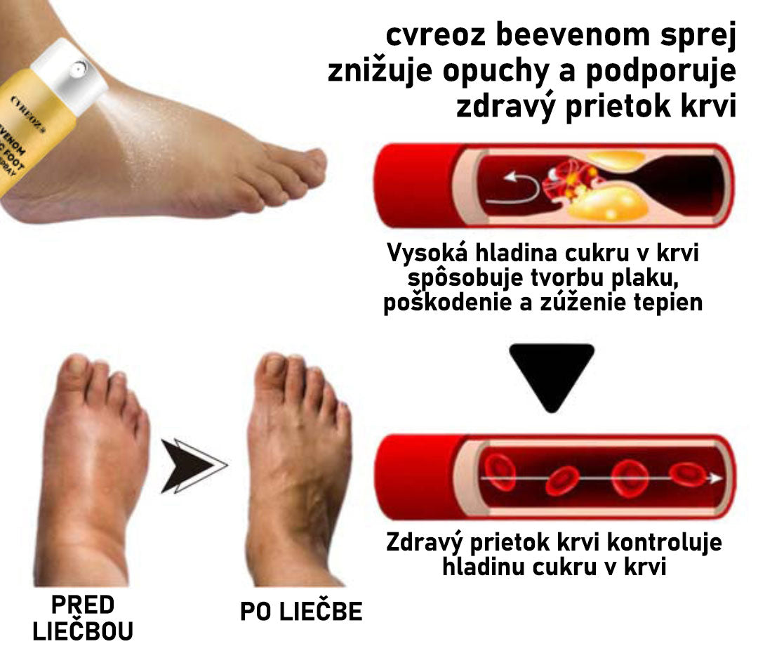 CVREOZ® Bee Venom Sprej na liečbu diabetickej nohy 🔥 Akcia na obmedzený čas – 60 % zľava 🔥🔥