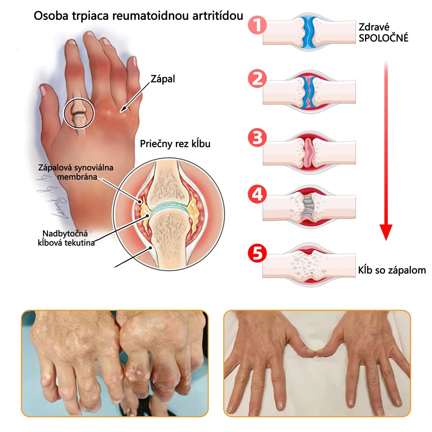 🦴ADNOON® Krém na hojenie kostí s botulotoxínom a včelím jedom ⭐👨⚕️Schválené Slovenskou spoločnosťou ortopedie a traumatológie (SOTS)🦴