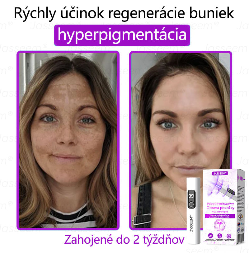 𝐉𝐚𝐬𝐬𝐞𝐞𝐦® Pokročilé neinvazívne CO₂ laserové pero na opravu pokožky 💕 (Jemne odstraňuje bradavice, materské znamienka, starecké škvrny a kožné výrastky – bez bolesti, bez starostí!) 💕