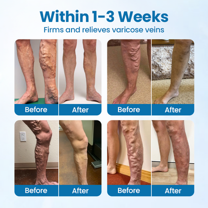 Timilk® VeinGuard bylinný sprej -✅ Klinicky preukázané odstránenie kŕčových žíl už za 7 dní!