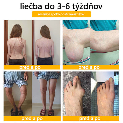 🦴ADNOON® Krém na hojenie kostí s botulotoxínom a včelím jedom ⭐👨‍⚕️Schválené Slovenskou spoločnosťou ortopedie a traumatológie (SOTS)🦴