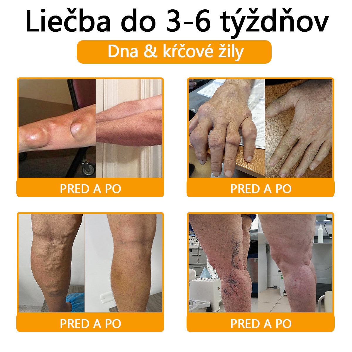 🦴ADNOON® Krém na hojenie kostí s botulotoxínom a včelím jedom ⭐👨‍⚕️Schválené Slovenskou spoločnosťou ortopedie a traumatológie (SOTS)🦴