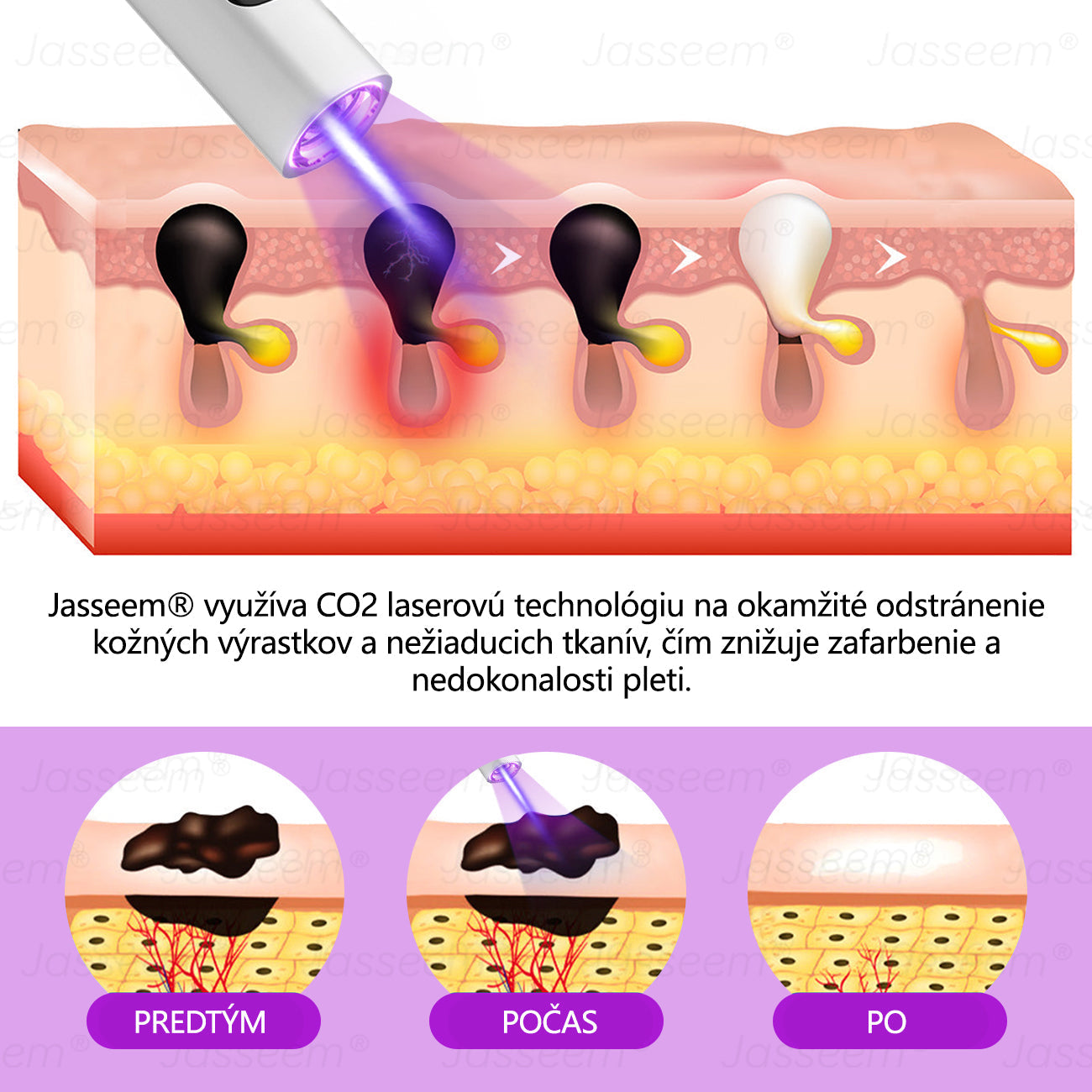 𝐉𝐚𝐬𝐬𝐞𝐞𝐦® Pokročilé neinvazívne CO₂ laserové pero na opravu pokožky 💕 (Jemne odstraňuje bradavice, materské znamienka, starecké škvrny a kožné výrastky – bez bolesti, bez starostí!) 💕