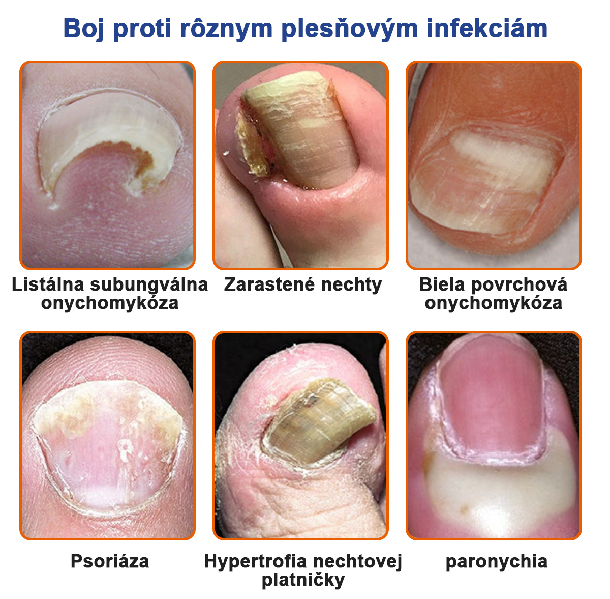 🐝Furzero™ Včelí jed na plesne na nechtoch: kompletné riešenie plesní na nechtoch 🌟👣👣