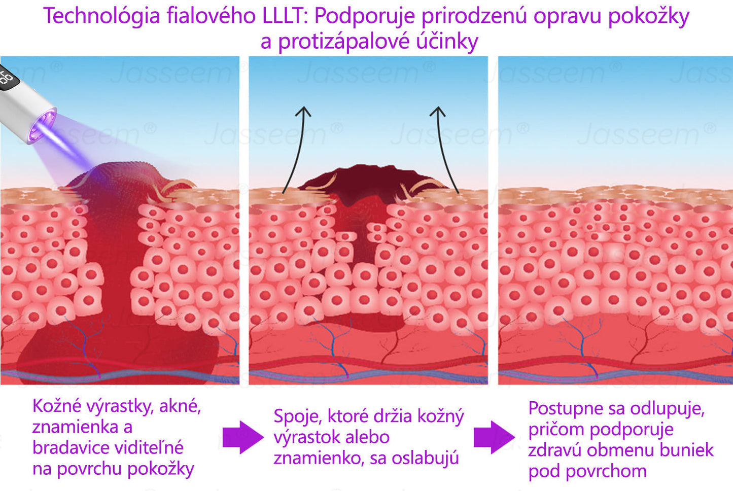 𝐉𝐚𝐬𝐬𝐞𝐞𝐦® Pokročilé neinvazívne CO₂ laserové pero na opravu pokožky 💕 (Jemne odstraňuje bradavice, materské znamienka, starecké škvrny a kožné výrastky – bez bolesti, bez starostí!) 💕