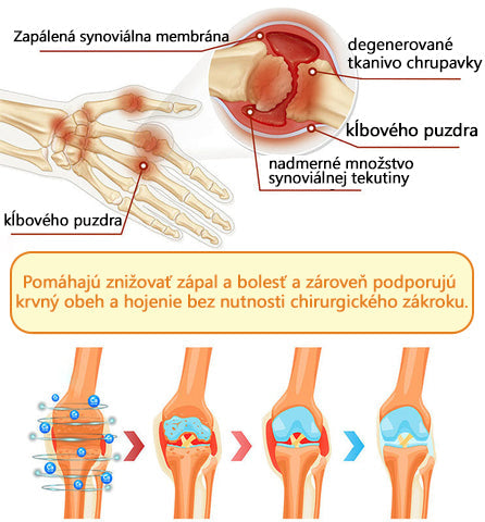 🦴ADNOON® Krém na hojenie kostí s botulotoxínom a včelím jedom ⭐👨‍⚕️Schválené Slovenskou spoločnosťou ortopedie a traumatológie (SOTS)🦴
