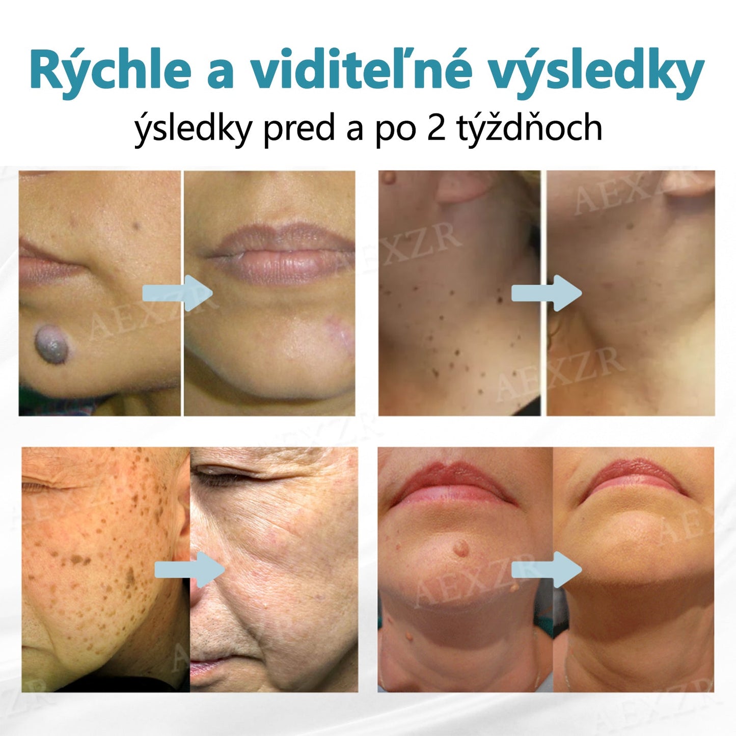 Bikenda® Neinvazívne laserové pero na odstránenie znamienok a bradavíc✨