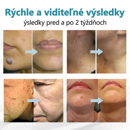 Bikenda® Neinvazívne laserové pero na odstránenie znamienok a bradavíc✨