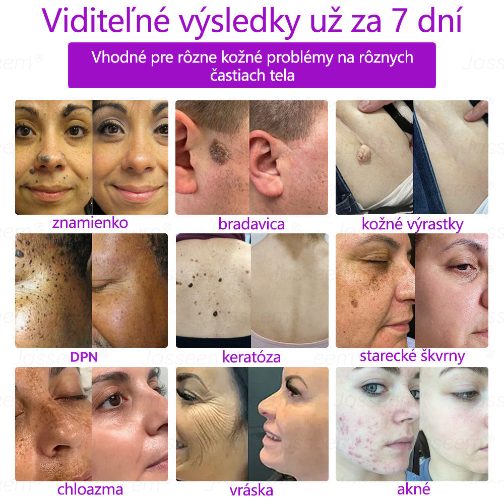 𝐉𝐚𝐬𝐬𝐞𝐞𝐦® Pokročilé neinvazívne CO₂ laserové pero na opravu pokožky 💕 (Jemne odstraňuje bradavice, materské znamienka, starecké škvrny a kožné výrastky – bez bolesti, bez starostí!) 💕