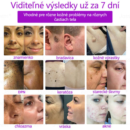 𝐉𝐚𝐬𝐬𝐞𝐞𝐦® Pokročilé neinvazívne CO₂ laserové pero na opravu pokožky 💕 (Jemne odstraňuje bradavice, materské znamienka, starecké škvrny a kožné výrastky – bez bolesti, bez starostí!) 💕