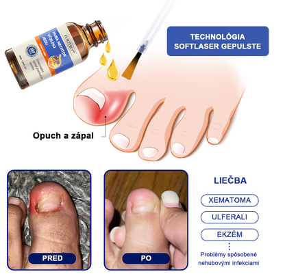 🐝Furzero™ Včelí jed na plesne na nechtoch: kompletné riešenie plesní na nechtoch 🌟👣👣