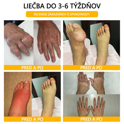 🦴ADNOON® Krém na hojenie kostí s botulotoxínom a včelím jedom ⭐👨‍⚕️Schválené Slovenskou spoločnosťou ortopedie a traumatológie (SOTS)🦴