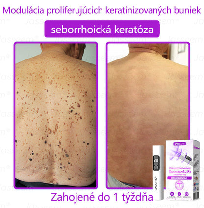 𝐉𝐚𝐬𝐬𝐞𝐞𝐦® Pokročilé neinvazívne CO₂ laserové pero na opravu pokožky 💕 (Jemne odstraňuje bradavice, materské znamienka, starecké škvrny a kožné výrastky – bez bolesti, bez starostí!) 💕