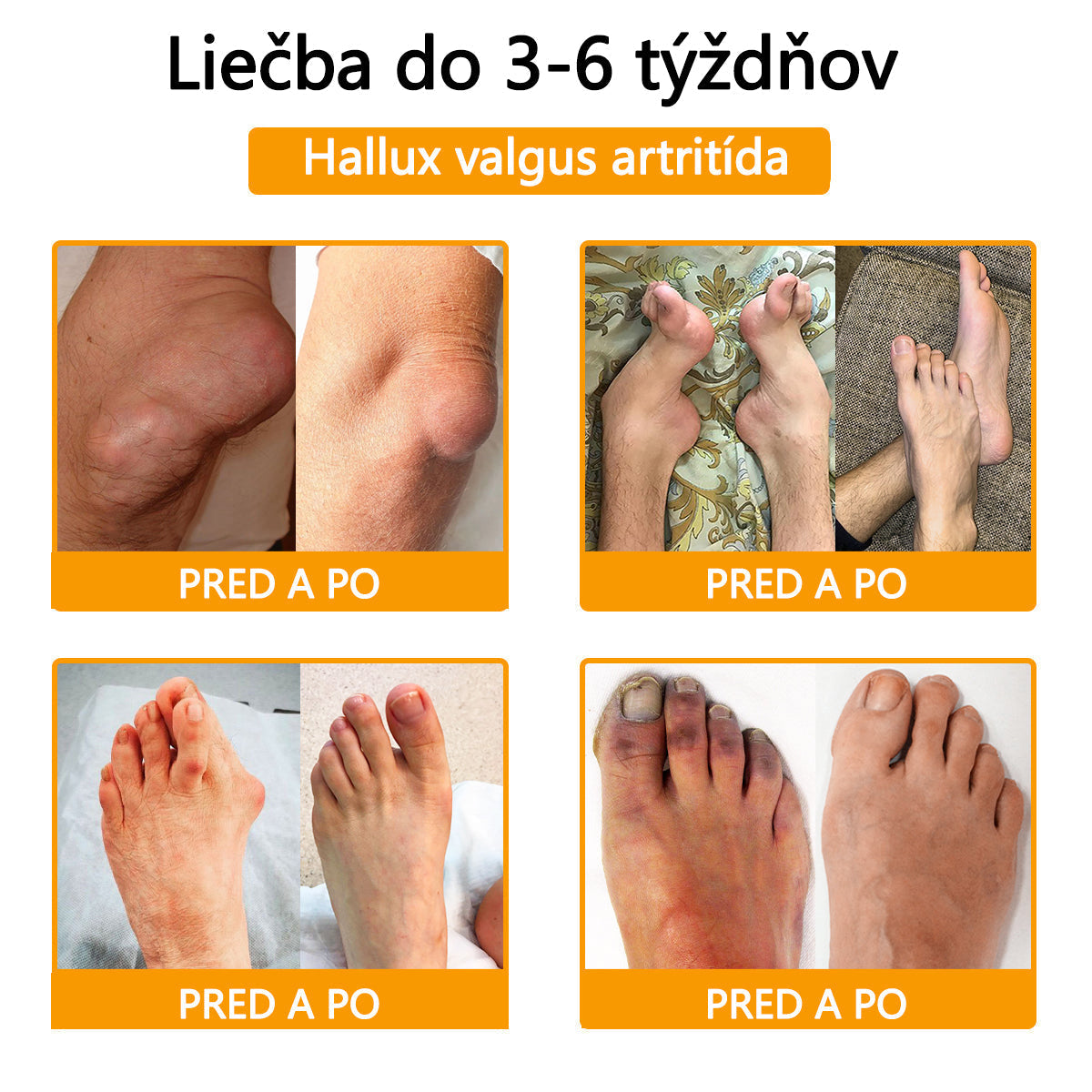 🦴ADNOON® Krém na hojenie kostí s botulotoxínom a včelím jedom ⭐👨‍⚕️Schválené Slovenskou spoločnosťou ortopedie a traumatológie (SOTS)🦴