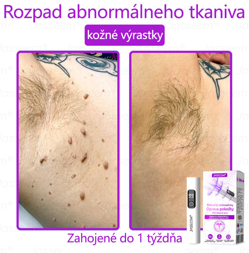 𝐉𝐚𝐬𝐬𝐞𝐞𝐦® Pokročilé neinvazívne CO₂ laserové pero na opravu pokožky 💕 (Jemne odstraňuje bradavice, materské znamienka, starecké škvrny a kožné výrastky – bez bolesti, bez starostí!) 💕