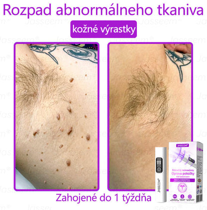 𝐉𝐚𝐬𝐬𝐞𝐞𝐦® Pokročilé neinvazívne CO₂ laserové pero na opravu pokožky 💕 (Jemne odstraňuje bradavice, materské znamienka, starecké škvrny a kožné výrastky – bez bolesti, bez starostí!) 💕